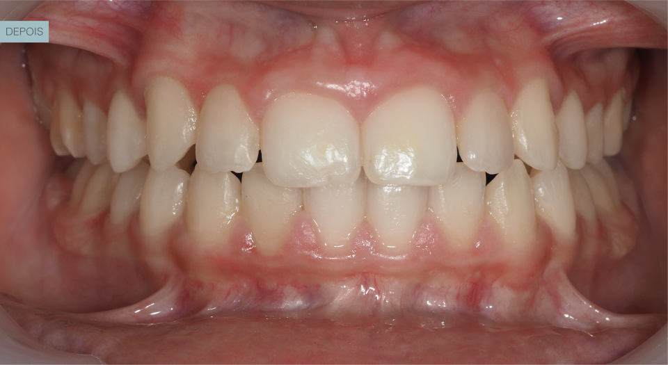 Ortodontia - Caso clínico 2 #2