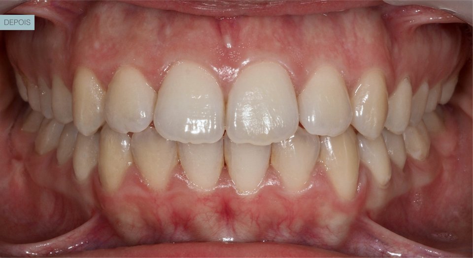 Ortodontia - Caso clínico 1 #4